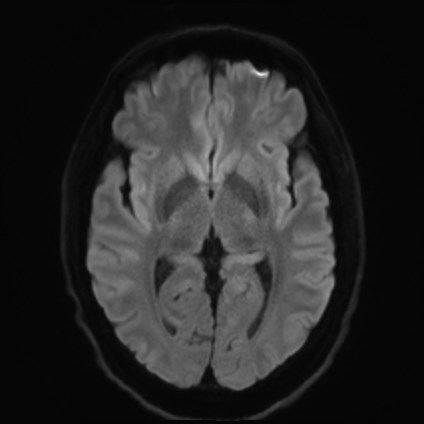 File:Amyotrophic lateral sclerosis (Radiopaedia 87352-103658 Axial DWI 41).jpg