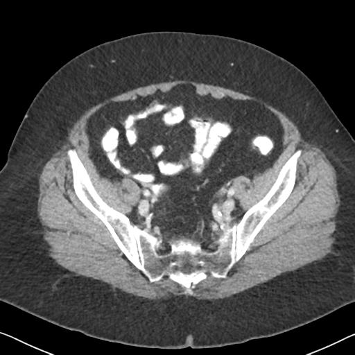 Anal adenocarcinoma - tumor regression grade 1 (Radiopaedia 31358-32103 Axial POST 58).jpg