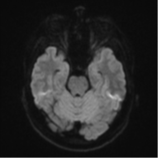 Anaplastic astrocytoma (Radiopaedia 57768-64731 Axial DWI 37).png