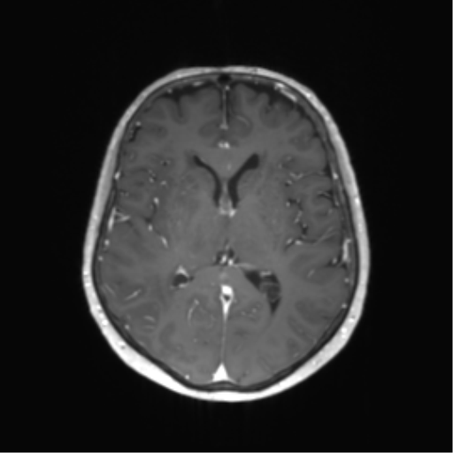 File:Anaplastic astrocytoma (Radiopaedia 86943-103160 Axial T1 C+ 31).png