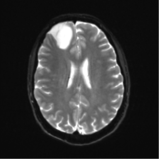 File:Anaplastic astrocytoma IDH mutant (Radiopaedia 50046-55341 Axial DWI 18).png
