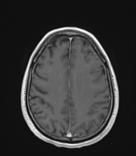 Anaplastic astrocytoma IDH wild-type (Radiopaedia 49984-55273 Axial T1 C+ 41).png