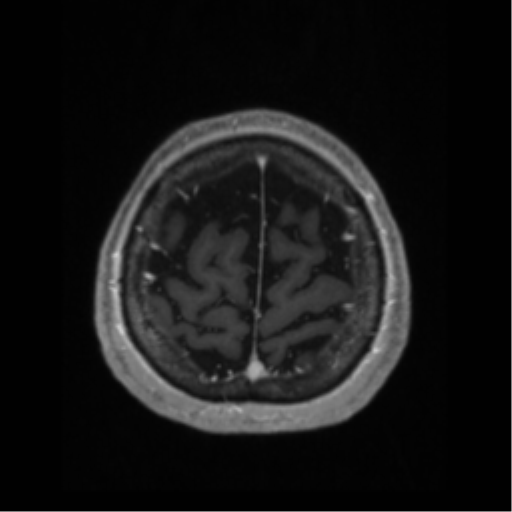 Anaplastic astrocytoma IDH wild-type (pseudoprogression) (Radiopaedia 42209-45276 Axial T1 C+ 128).png