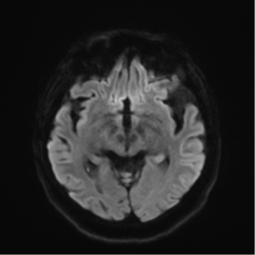 Anaplastic astrocytoma IDH wild-type (pseudoprogression) (Radiopaedia 42209-45279 Axial DWI 39).png