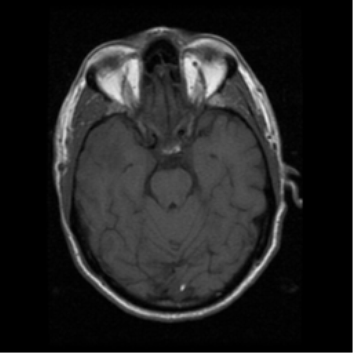 File:Anaplastic meningioma with recurrence (Radiopaedia 34452-35783 Axial T1 7).png