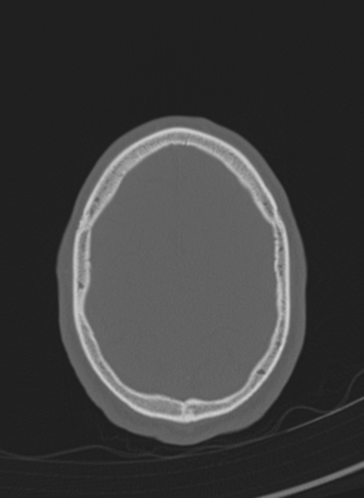 Anaplastic oligodendroglioma with skull fracture (Radiopaedia 74831-85846 Axial bone window 2).png