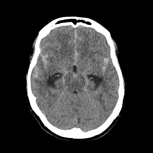 Aneursym related subarachnoid hemorrhage with hydrocephalus (Radiopaedia 45105-49083 Axial non-contrast 17).jpg