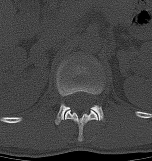 Aneurysmal bone cyst T11 (Radiopaedia 29294-29721 Axial bone window 60).jpg