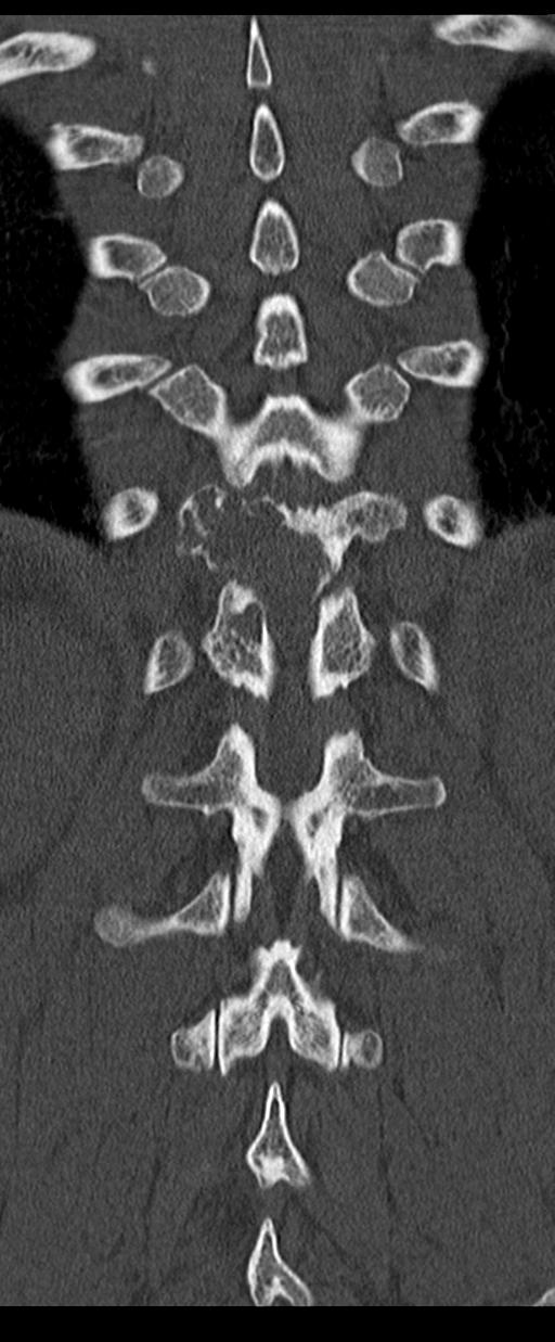 Aneurysmal bone cyst T11 (Radiopaedia 29294-29721 Coronal bone window 47).jpg