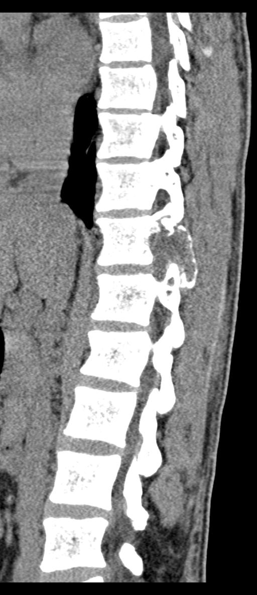 Aneurysmal bone cyst T11 (Radiopaedia 29294-29721 E 47).jpg