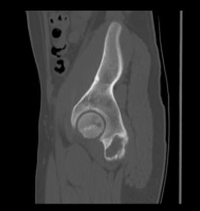 Aneurysmal bone cyst of ischium (Radiopaedia 25957-26094 Sagittal bone window 54).png