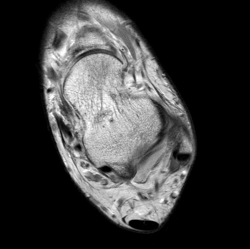 File:Aneurysmal bone cyst of the calcaneus (Radiopaedia 60669-68420 Axial PD 18).jpg