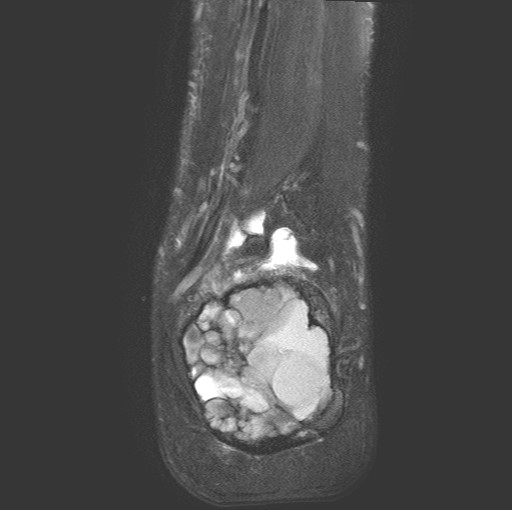File:Aneurysmal bone cyst of the calcaneus (Radiopaedia 60669-68420 Coronal T2 fat sat 18).jpg