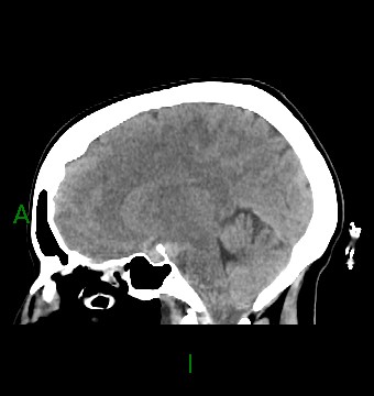 File:Aneurysmal subarachnoid hemorrhage with intra-axial extension (Radiopaedia 84371-99699 B 24).jpg