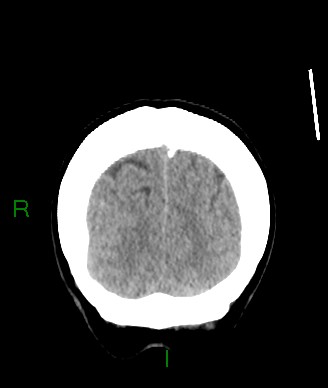 Aneurysmal subarachnoid hemorrhage with intra-axial extension (Radiopaedia 84371-99699 Coronal non-contrast 12).jpg