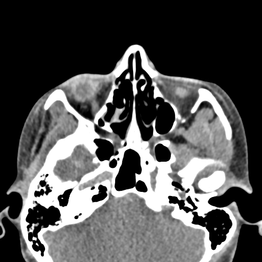 Angular dermoid cyst (Radiopaedia 88967-105790 Axial non-contrast 21).jpg