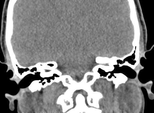 Angular dermoid cyst (Radiopaedia 88967-105790 Coronal non-contrast 76).jpg