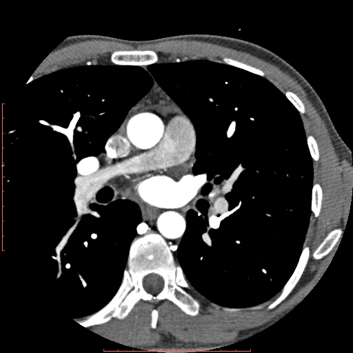 Anomalous left coronary artery from the pulmonary artery (ALCAPA) (Radiopaedia 70148-80181 A 28).jpg