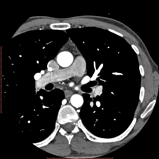 Anomalous left coronary artery from the pulmonary artery (ALCAPA) (Radiopaedia 70148-80181 A 8).jpg