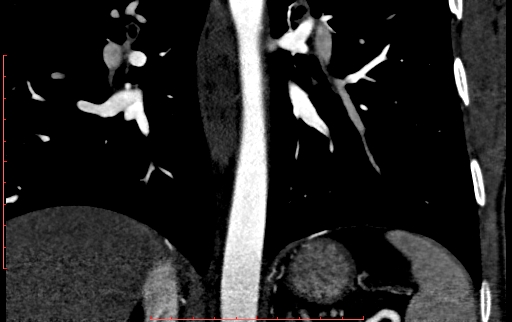 Anomalous left coronary artery from the pulmonary artery (ALCAPA) (Radiopaedia 70148-80181 B 243).jpg