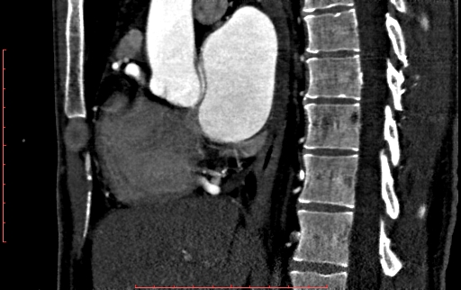 File:Anomalous left coronary artery from the pulmonary artery (ALCAPA) (Radiopaedia 70148-80181 C 100).jpg