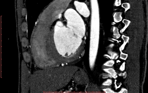 File:Anomalous left coronary artery from the pulmonary artery (ALCAPA) (Radiopaedia 70148-80181 C 145).jpg