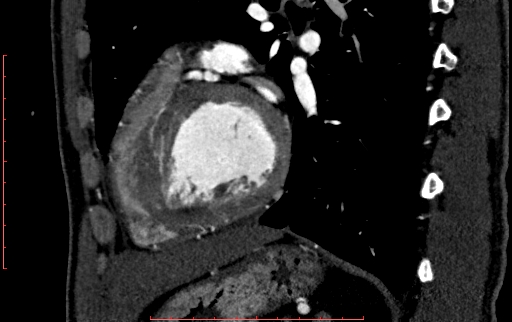 File:Anomalous left coronary artery from the pulmonary artery (ALCAPA) (Radiopaedia 70148-80181 C 175).jpg
