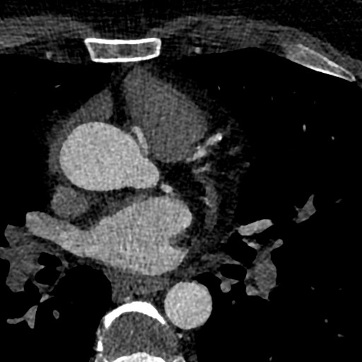 File:Anomalous origin of the left coronary artery with malignant course (Radiopaedia 77842-90126 C 33).jpeg