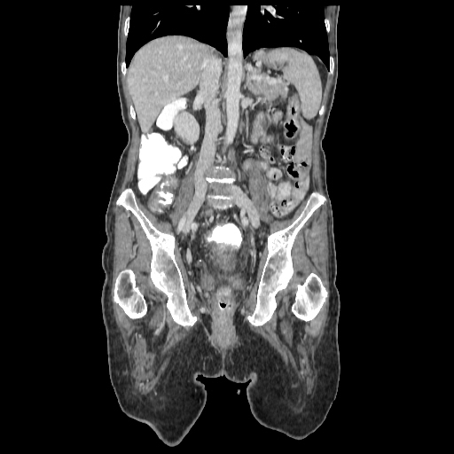 Anorectal carcinoma (Radiopaedia 44413-48064 B 47).jpg