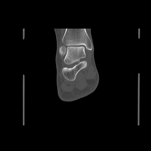 File:Anterior calcaneal process fracture (Radiopaedia 82590-96762 Coronal bone window 56).jpg