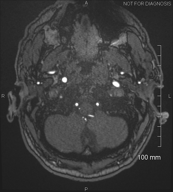 Anterior cerebral artery aneurysm (Radiopaedia 80683-94127 Axial MRA 13).jpg