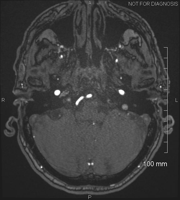 Anterior cerebral artery aneurysm (Radiopaedia 80683-94127 Axial MRA 43).jpg