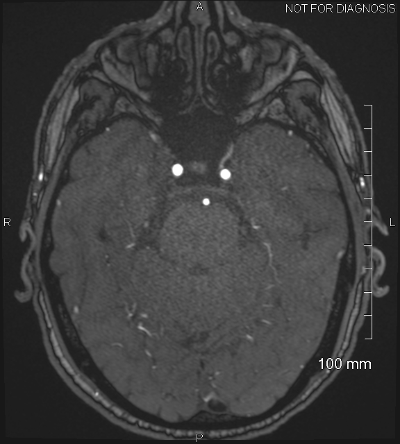 Anterior cerebral artery aneurysm (Radiopaedia 80683-94127 Axial MRA 74).jpg