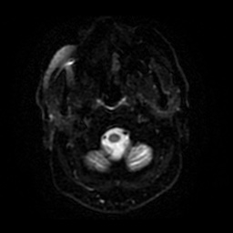 Anterior cerebral artery infarction (Radiopaedia 46794-51323 Axial DWI 30).jpg