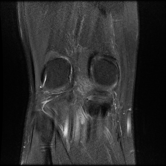 File:Anterior cruciate ligament graft tear and bucket-handle tear of medial meniscus (Radiopaedia 75867-87254 Coronal PD fat sat 19).jpg
