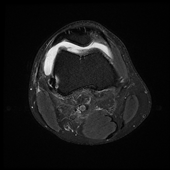 File:Anterior cruciate ligament graft tear and bucket-handle tear of medial meniscus (Radiopaedia 75867-87255 Axial PD fat sat 19).jpg