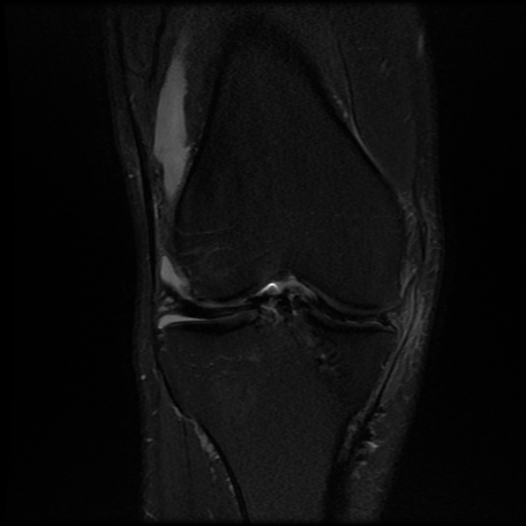 File:Anterior cruciate ligament graft tear and bucket-handle tear of medial meniscus (Radiopaedia 75867-87255 Coronal PD fat sat 12).jpg