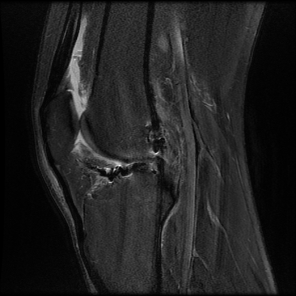 File:Anterior cruciate ligament graft tear and bucket-handle tear of medial meniscus (Radiopaedia 75867-87255 Sagittal PD fat sat 16).jpg