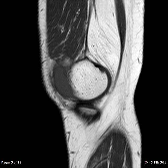File:Anterior cruciate ligament tear (Radiopaedia 70783-80964 Sagittal T1 5).jpg