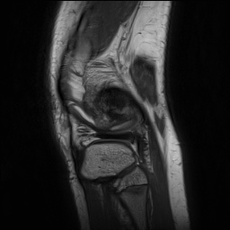 File:Anterior cruciate ligament tear - pediatric (Radiopaedia 62152-70260 Sagittal PD 147).jpg