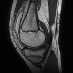 Anterior cruciate ligament tear - pediatric (Radiopaedia 62152-70260 Sagittal PD 56).jpg