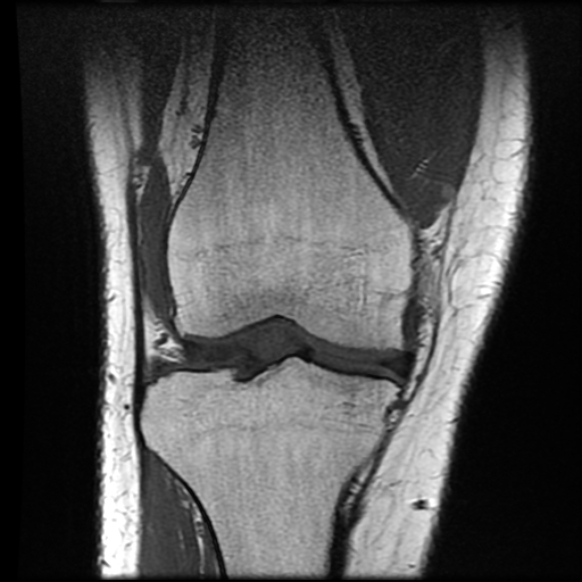 File:Anterior cruciate ligament tear with posteromedial corner injury, bucket-handle meniscal tear and chondral delamination (Radiopaedia 75501-86744 Coronal T1 11).jpg