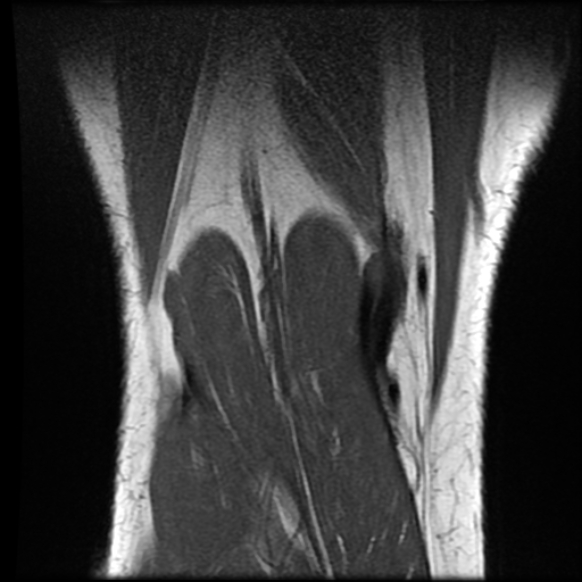 File:Anterior cruciate ligament tear with posteromedial corner injury, bucket-handle meniscal tear and chondral delamination (Radiopaedia 75501-86744 Coronal T1 24).jpg