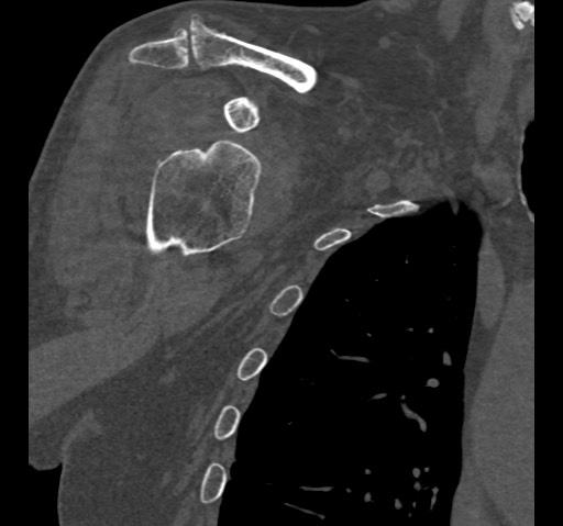File:Anterior glenohumeral dislocation with Hill-Sachs lesion (Radiopaedia 62877-71249 Coronal bone window 28).jpg