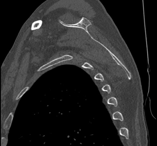 Anterior glenohumeral dislocation with Hill-Sachs lesion (Radiopaedia 62877-71249 Sagittal bone window 50).jpg