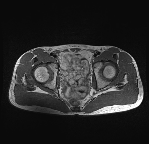 File:Anterior inferior iliac spine avulsion fracture (Radiopaedia 81312-95000 Axial T1 18).jpg