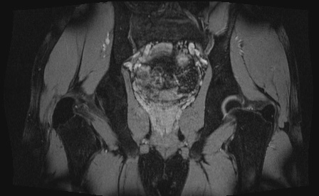 Anterior inferior iliac spine avulsion fracture (Radiopaedia 81312-95000 G 19).jpg