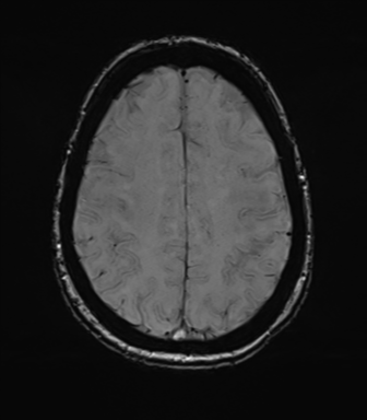 Anterior temporal pole cysts (Radiopaedia 46629-51102 Axial SWI 64).png