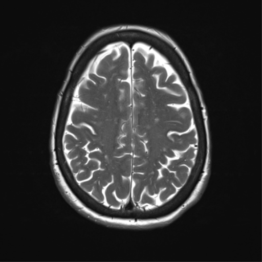 File:Anterior temporal pole cysts (Radiopaedia 46629-51102 C 28).png