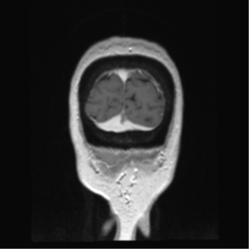 Anterior temporal pole cysts (Radiopaedia 46629-51102 Coronal T1 C+ 13).png